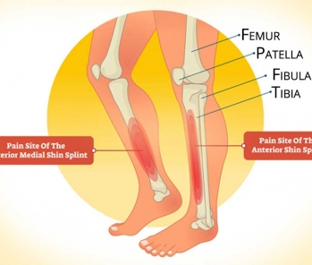 Shin Splints very common amongst people who play team sports