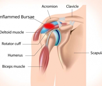 The symptoms and general cause of shoulder pain or frozen shoulder 
