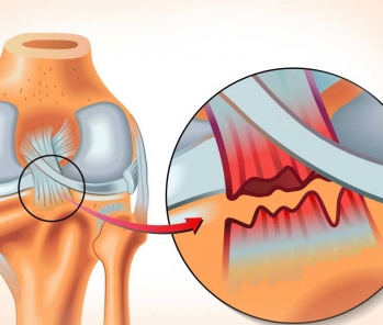 Self healing a knee posterior cruciate ligament injury with bio energy