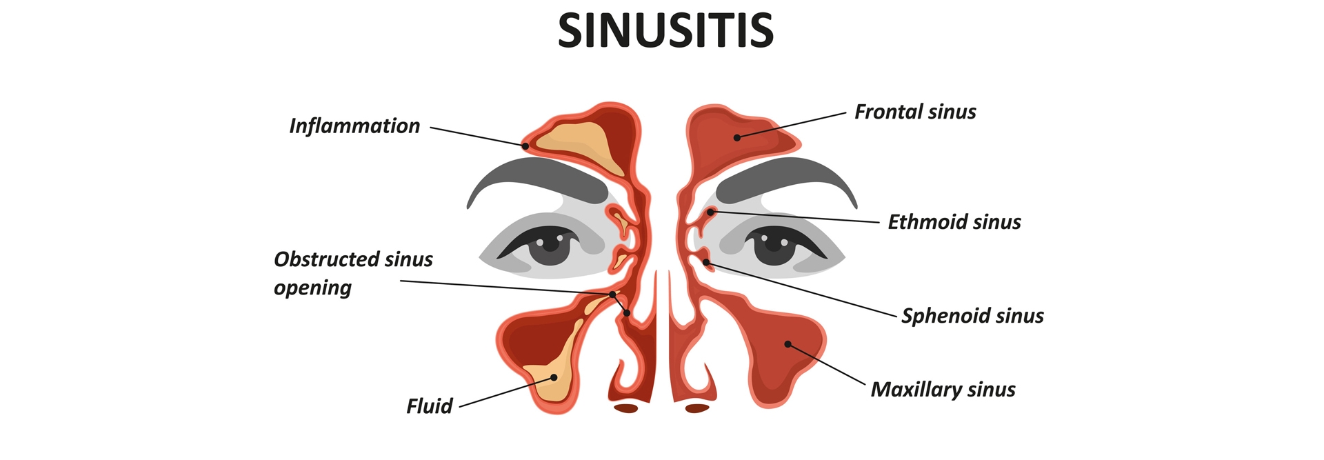 Sinus Headaches Can Be Related to Food Sensitivity- Self Healing Course