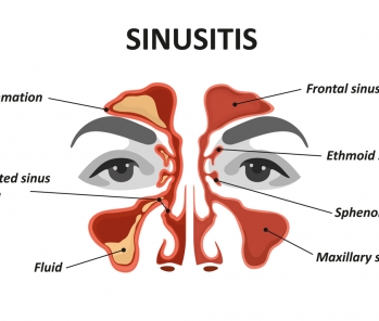 Sinus headaches and blocked sinuses related to food sensitivity